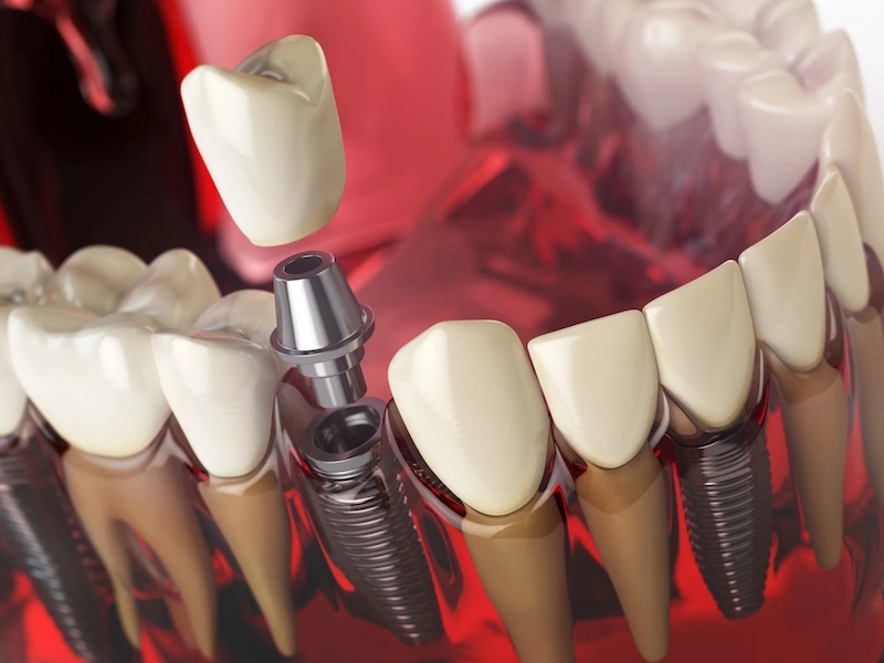 Dental implants in Orlando, FL